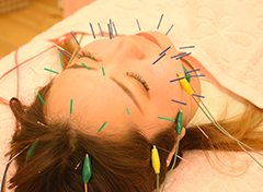 リフトアップ美容鍼