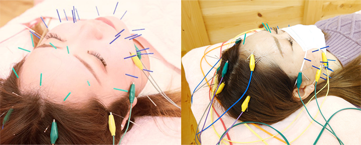 ご希望の方は、マスクをしたまま美容鍼が受けられます