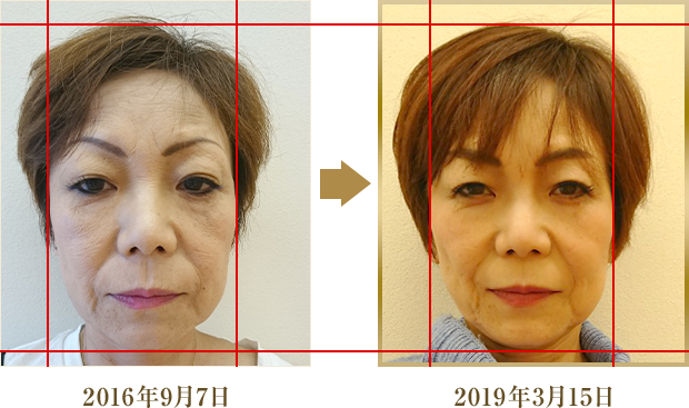 しわ・ゴルゴラインにお悩みだった